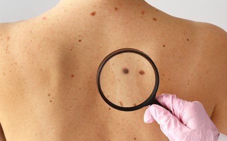 MELANOMAS: COMO IDENTIFICAR?