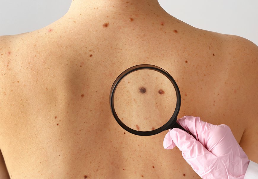 MELANOMAS: COMO IDENTIFICAR?