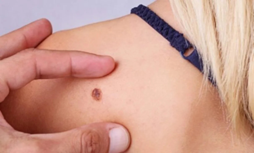 MELANOMAS: COMO IDENTIFICAR?