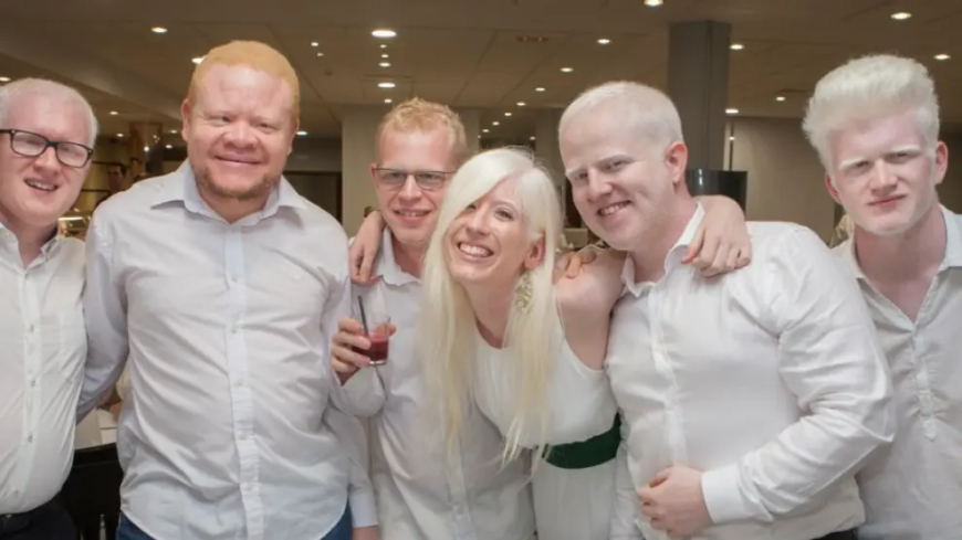 PRECONCEITO AFASTA ALBINOS DA CONVIVÊNCIA SOCIAL