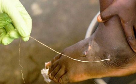 OMS REAFIRMA APOIO À ERRADICAÇÃO DO “VERME DA GUINÉ” NO CUNENE ATÉ 2030