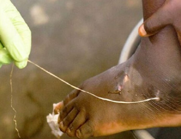 OMS REAFIRMA APOIO À ERRADICAÇÃO DO “VERME DA GUINÉ” NO CUNENE ATÉ 2030