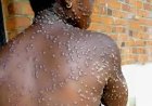 UÍGE REGISTA UM CASO POSITIVO DE MPOX E REFORÇA CAMPANHA DE VACINAÇÃO NAS ZONAS FRONTEIRIÇAS