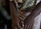 MINSA CONFIRMA CINCO NOVOS CASOS DE MPOX EM CABINDA E ALERTA PARA PROPAGAÇÃO DA DOENÇA