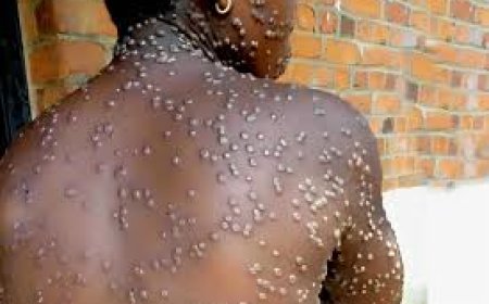 UÍGE REGISTA UM CASO POSITIVO DE MPOX E REFORÇA CAMPANHA DE VACINAÇÃO NAS ZONAS FRONTEIRIÇAS