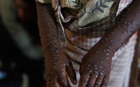 MINSA CONFIRMA CINCO NOVOS CASOS DE MPOX EM CABINDA E ALERTA PARA PROPAGAÇÃO DA DOENÇA