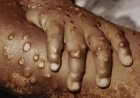 SUSPEITA DE MPOX NA PROVÍNCIA DE ICOLO E BENGO: MINSA DESCARTA QUALQUER POSSIBILIDADE DA EXISTÊNCIA DA DOENÇA