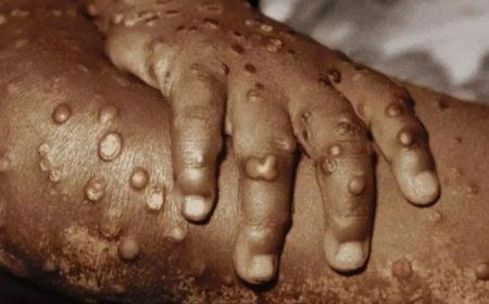 SUSPEITA DE MPOX NA PROVÍNCIA DE ICOLO E BENGO: MINSA DESCARTA QUALQUER POSSIBILIDADE DA EXISTÊNCIA DA DOENÇA