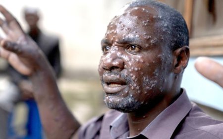 CABINDA RECEBE MAIS 30 MIL DOSES DE VACINAS PARA REFORÇAR COMBATE À MPOX