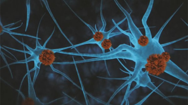 INTELIGÊNCIA ARTIFICIAL PODE IDENTIFICAR PACIENTES COM RISCO DE ALZHEIMER