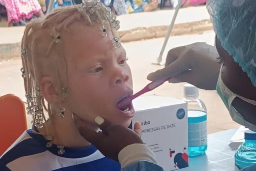 CAMPANHA REFORÇA ASSISTÊNCIA MÉDICA E INCLUSÃO DE PESSOAS COM ALBINISMO NO QUÉSSUA