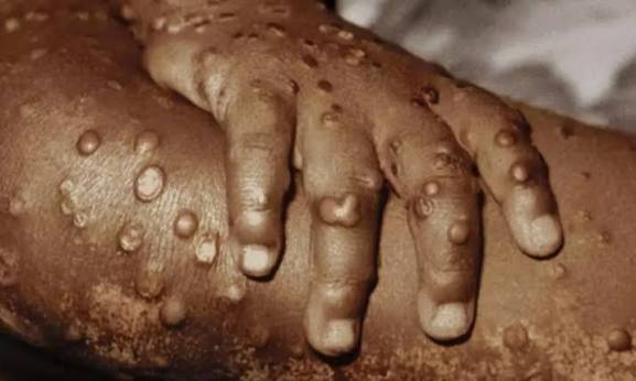 MPOX ACELERA EM ANGOLA E CHEGA A LUANDA COM 578 CASOS CONFIRMADOS