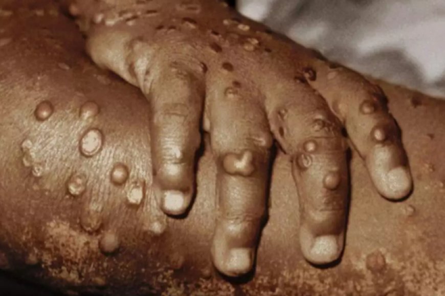 SUSPEITA DE MPOX NA PROVÍNCIA DE ICOLO E BENGO: MINSA DESCARTA QUALQUER POSSIBILIDADE DA EXISTÊNCIA DA DOENÇA