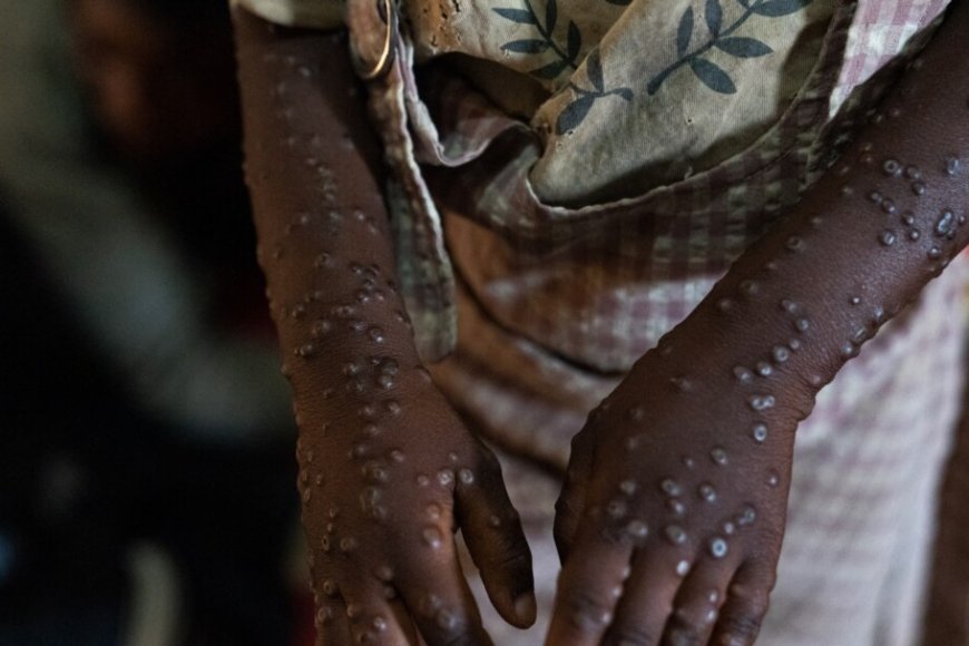 MINSA CONFIRMA CINCO NOVOS CASOS DE MPOX EM CABINDA E ALERTA PARA PROPAGAÇÃO DA DOENÇA