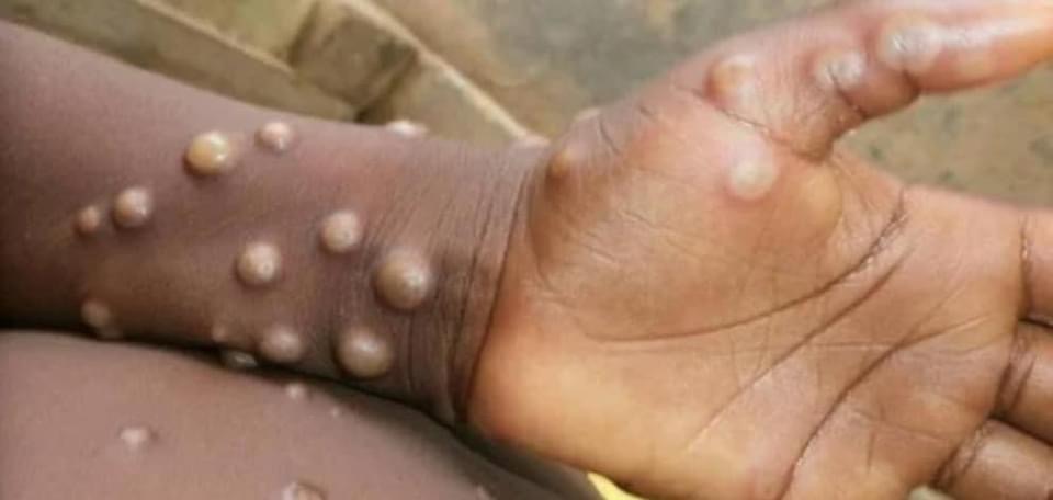 MPOX VOLTA A PRESSIONAR ANGOLA COM 19 NOVOS CASOS EM APENAS 24 HORAS