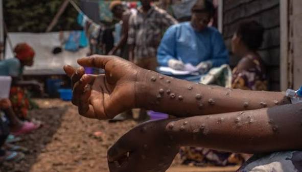 MPOX JÁ ATINGE NOVE PROVÍNCIAS DE ANGOLA E REFORÇA ALERTA SANITÁRIO NACIONAL