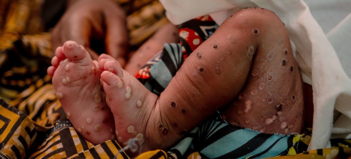 CUANZA-SUL ENTRA NO MAPA DA MPOX COM DOIS CASOS CONFIRMADOS
