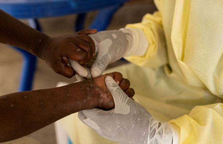 MPOX VOLTA A PRESSIONAR ANGOLA COM 19 NOVOS CASOS EM APENAS 24 HORAS