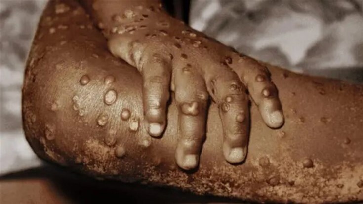 ZAIRE CONFIRMA PRIMEIRO CASO DE MPOX APÓS EXPOSIÇÃO A CARNE DE CAÇA