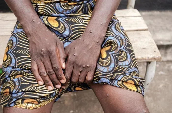MPOX: ANGOLA SOMA QUATRO NOVOS CASOS E MANTÉM 100 CASOS ACTIVOS